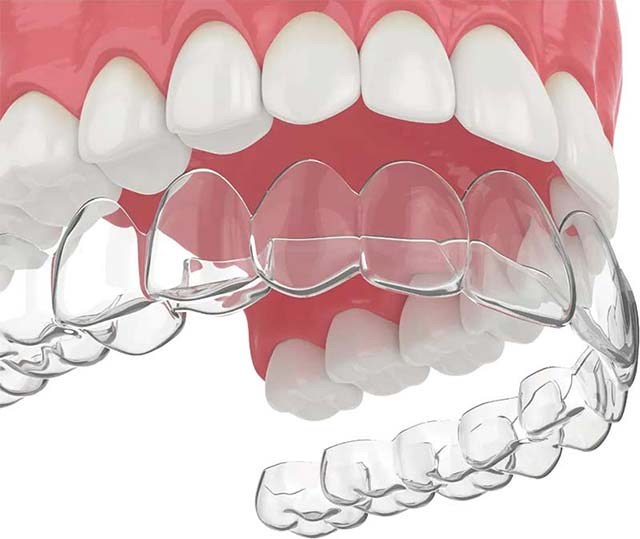 Invisalign & Clear aligners in Brentwood, CA