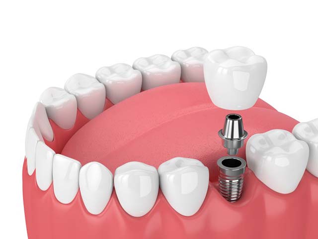 Dental Implants in Brentwood, CA