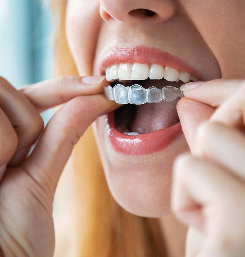 Female putting invisalign clear retainer on